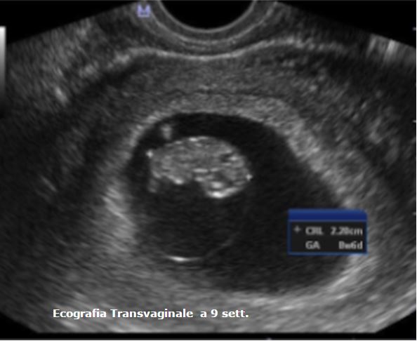 Ecografia transvaginale in gravidanza